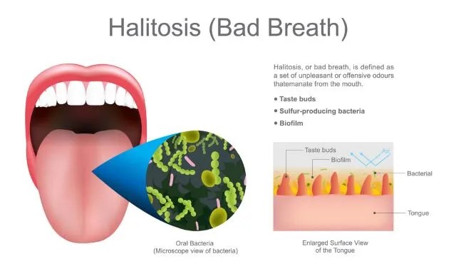 Halitosis