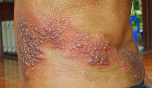 Herpes zoster virus on Skin