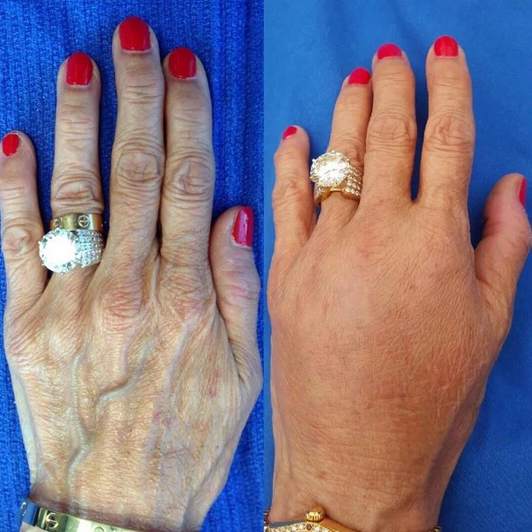 Dr. Devgan's expert commentary on how to get youngerlooking hands and