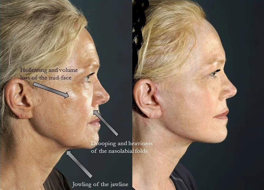 Dr. Devgan's approach to Facelift and Necklift Featured in Online