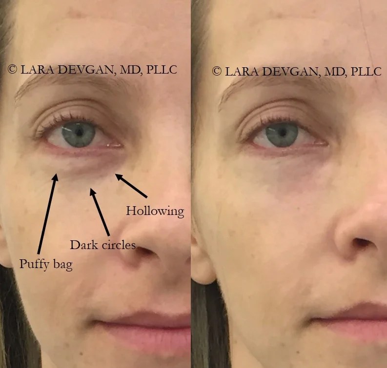 The spectrum of eye rejuvenation from injections to surgery — Lara