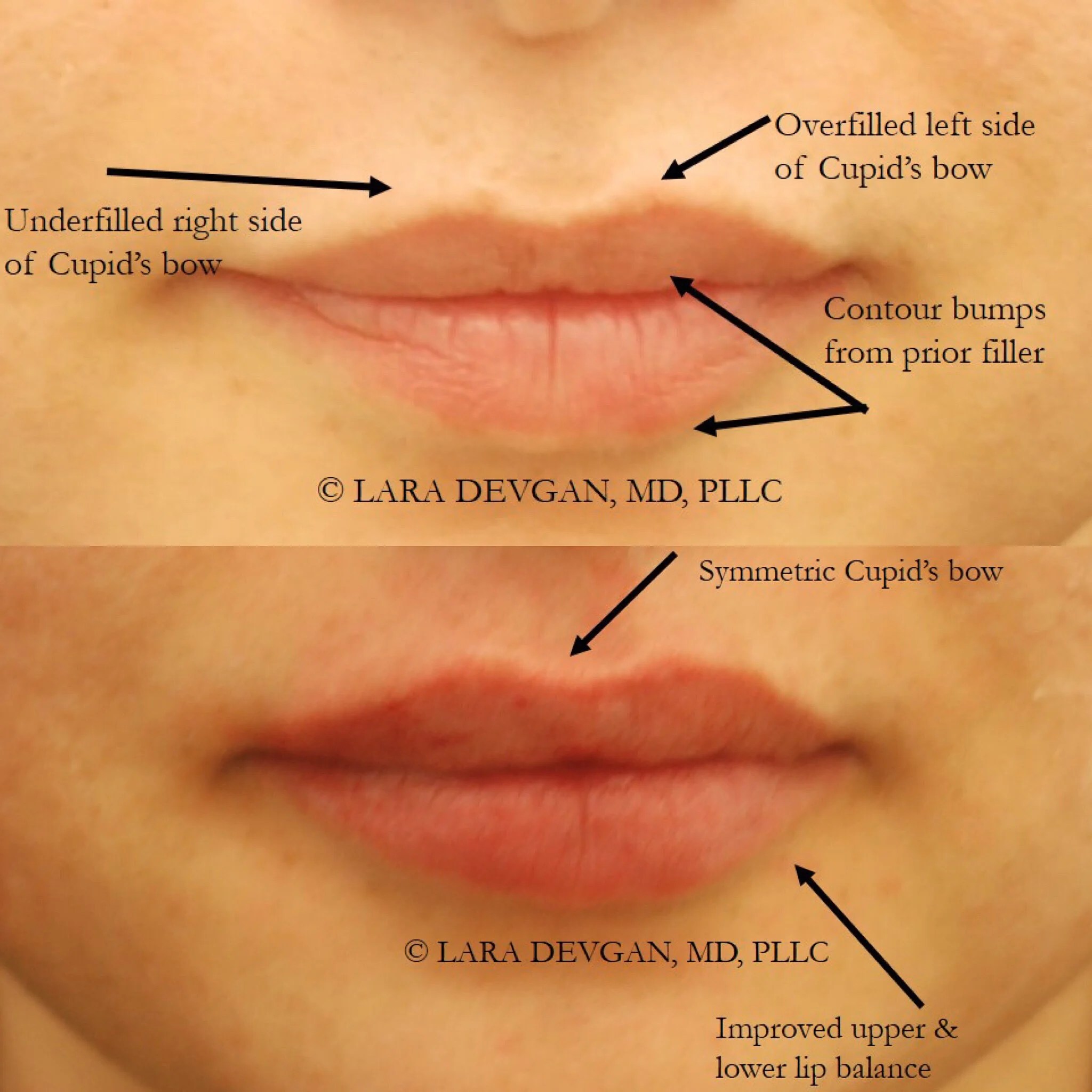 Correcting lip filler that is lumpy and bumpy — Lara Devgan, MD, MPH