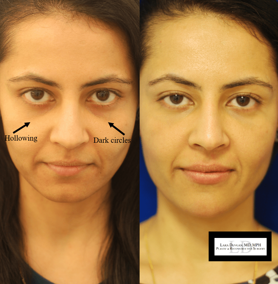 Collection 102+ Pictures Teardrop Implants Before And After Pictures