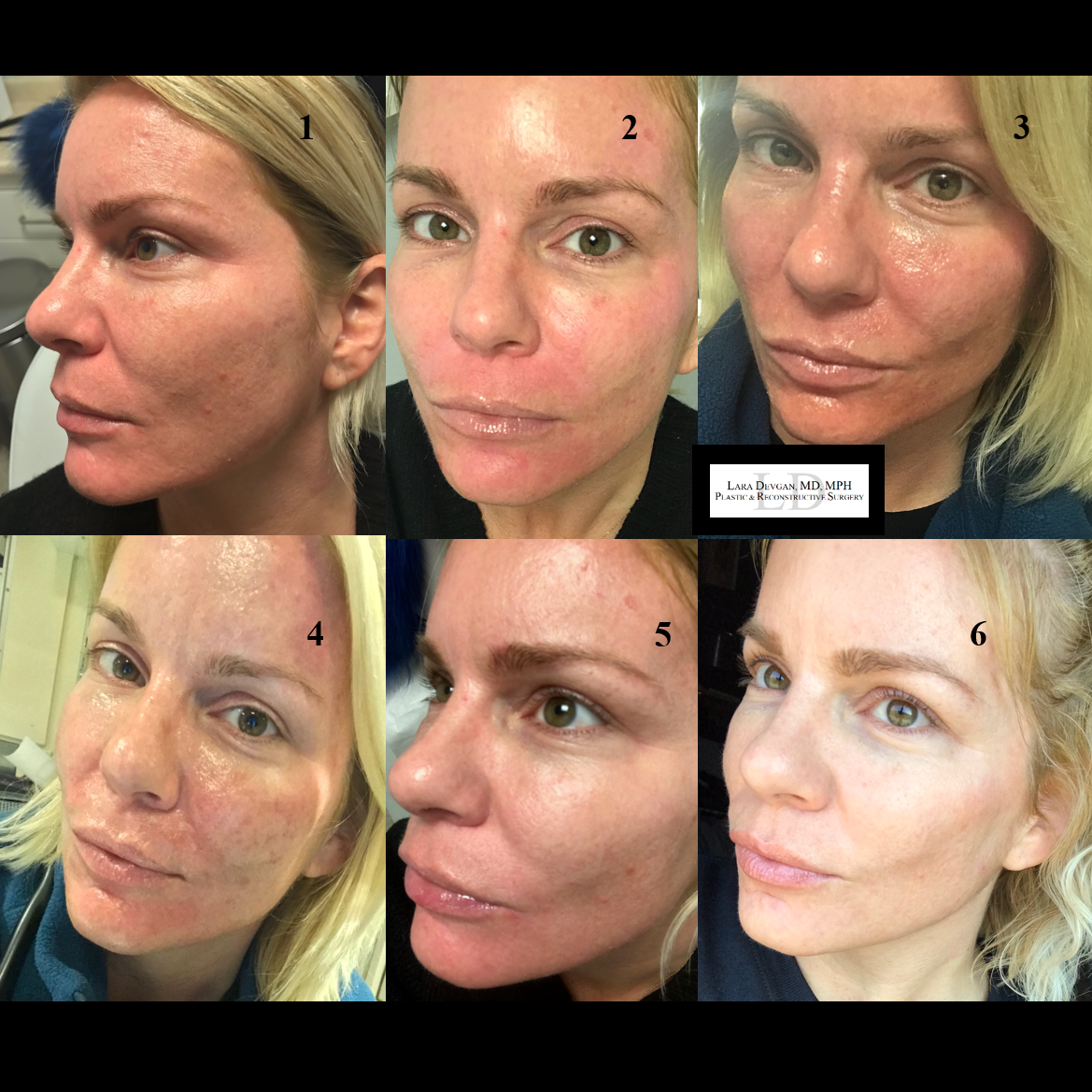 Medicalgrade chemical peels — Lara Devgan, MD, MPH, FACS