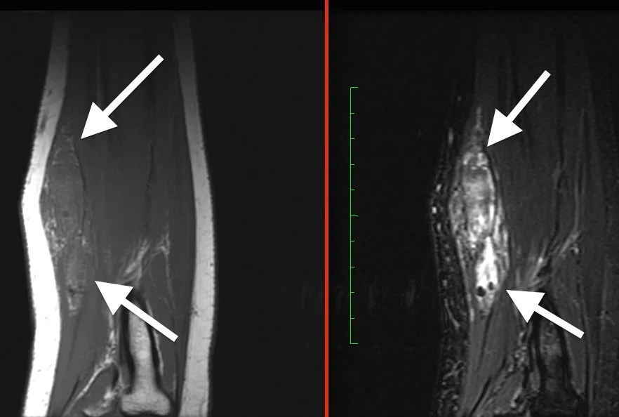 Benign Soft Tissue Tumors — Specialists