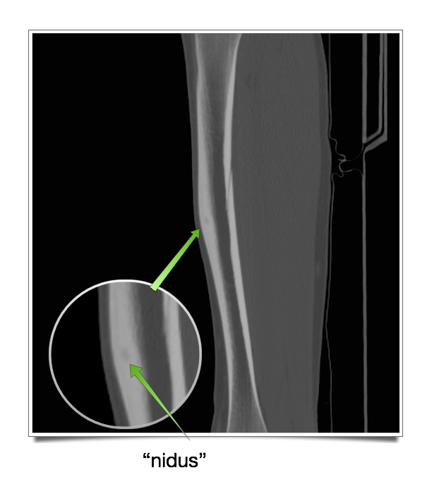 Benign Bone Tumors — Specialists