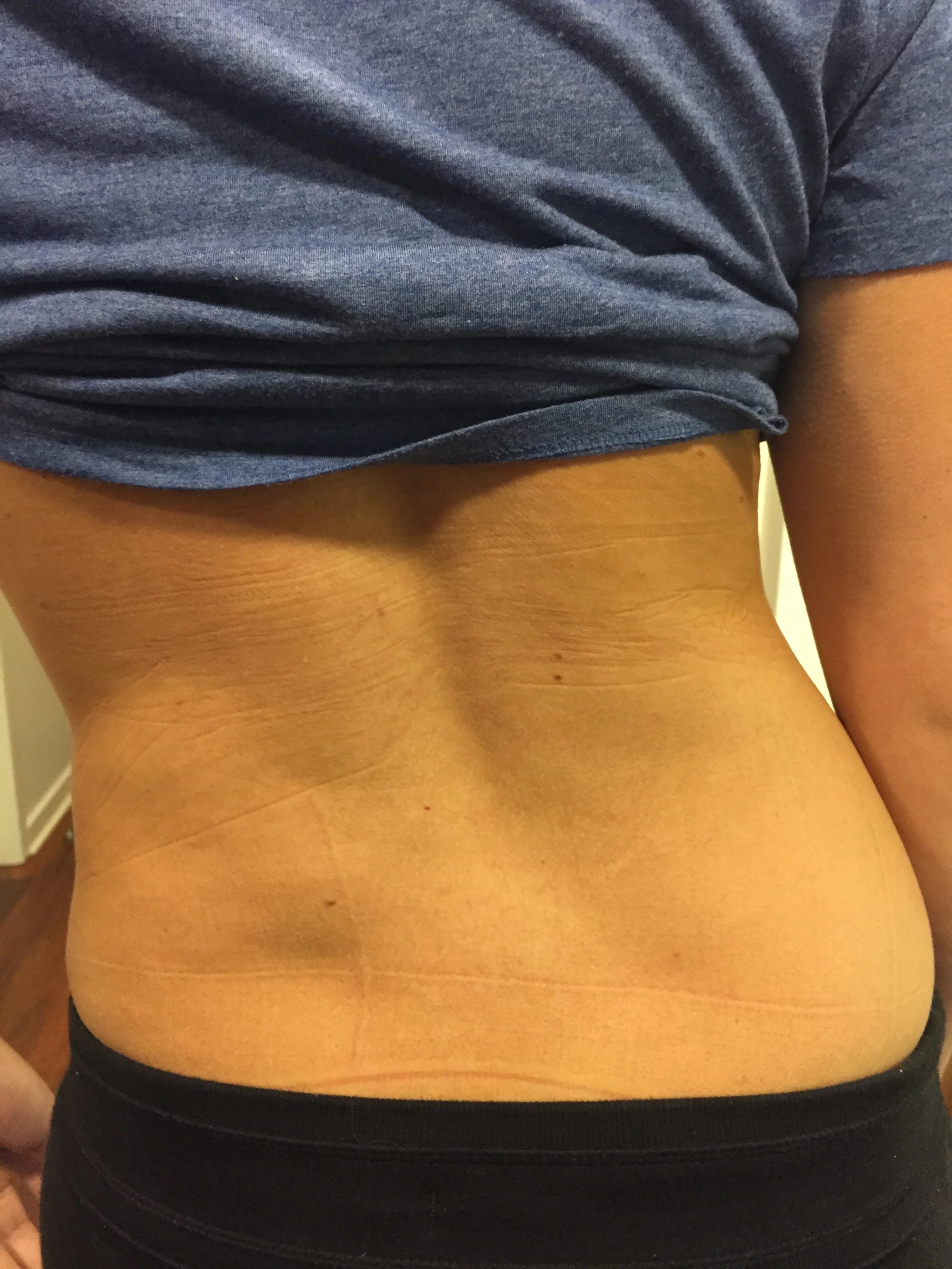 Lumbar disc herniation with radiculopathy a case study