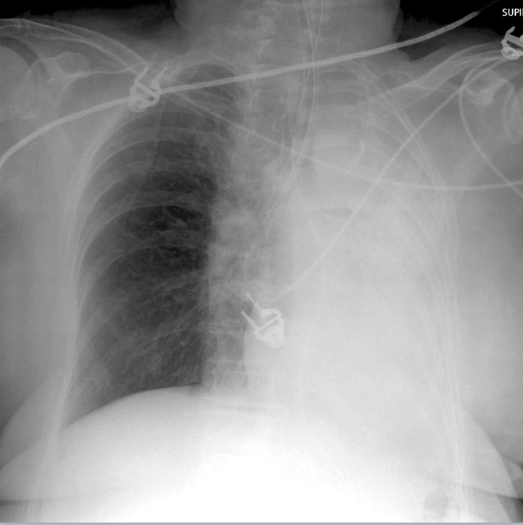 Interpreting Chest Xrays — Taming the SRU