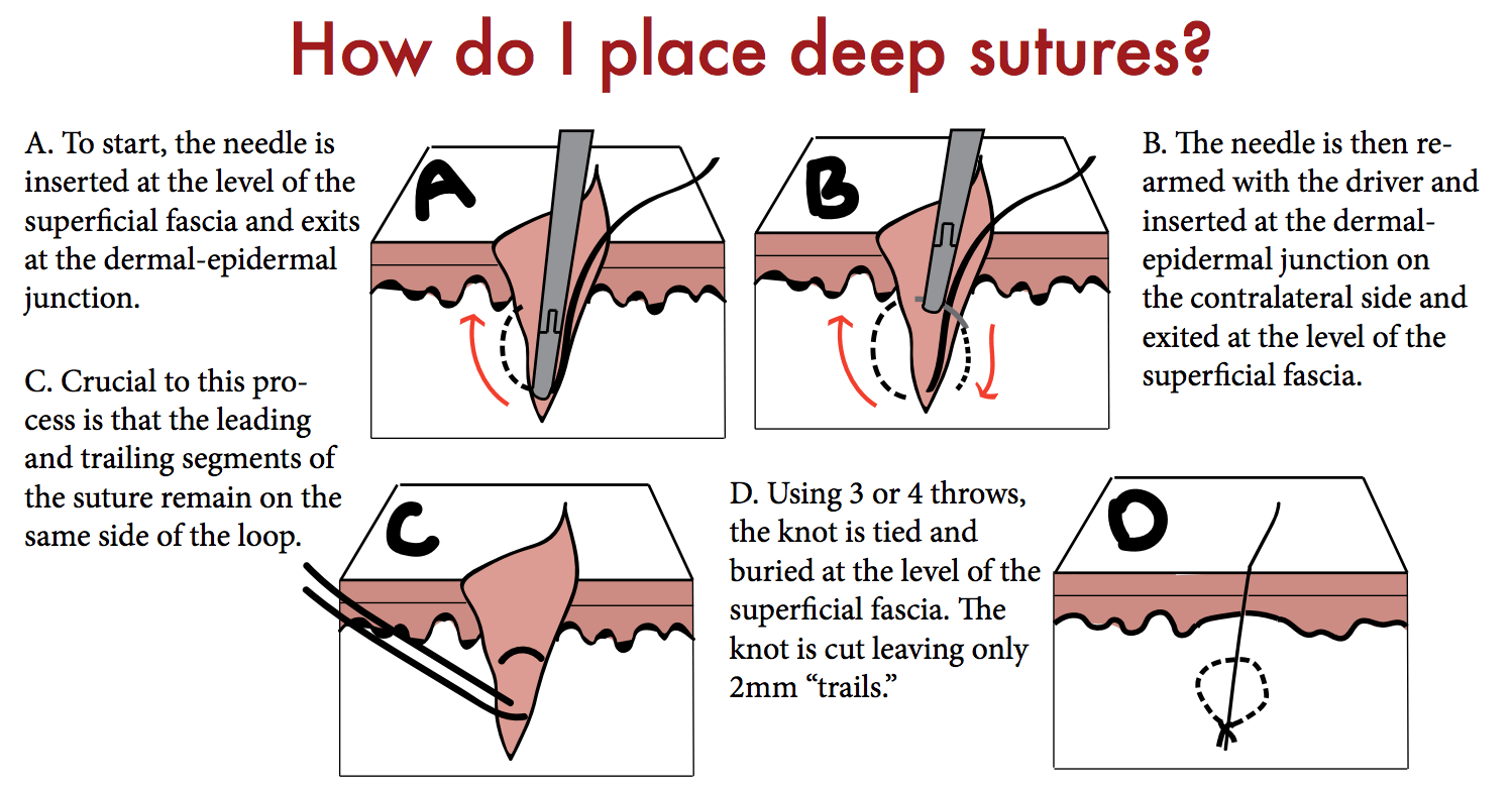 Closing the Gap Deep Sutures — Taming the SRU