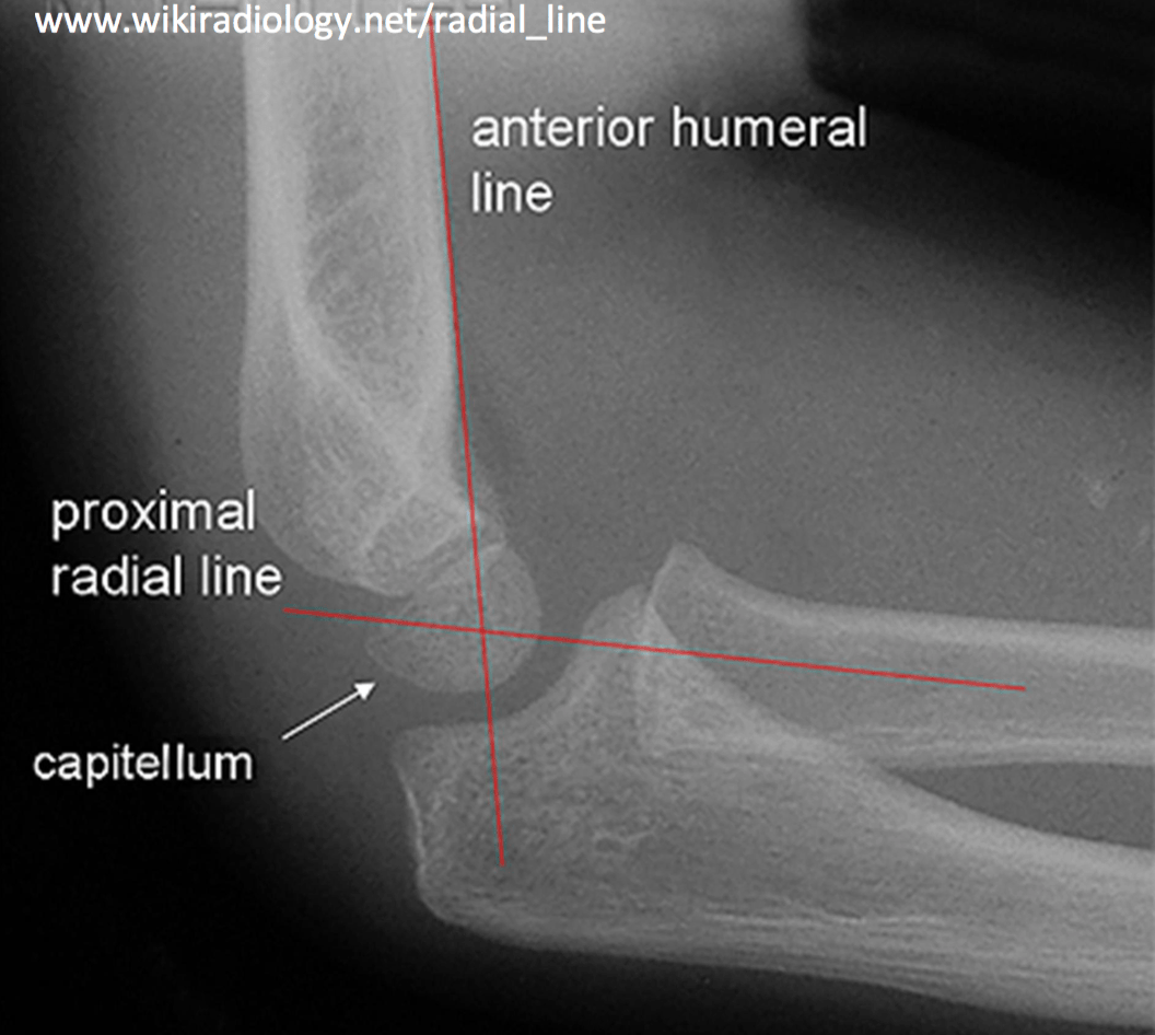 Interpreting Elbow and Forearm Radiographs — Taming the SRU