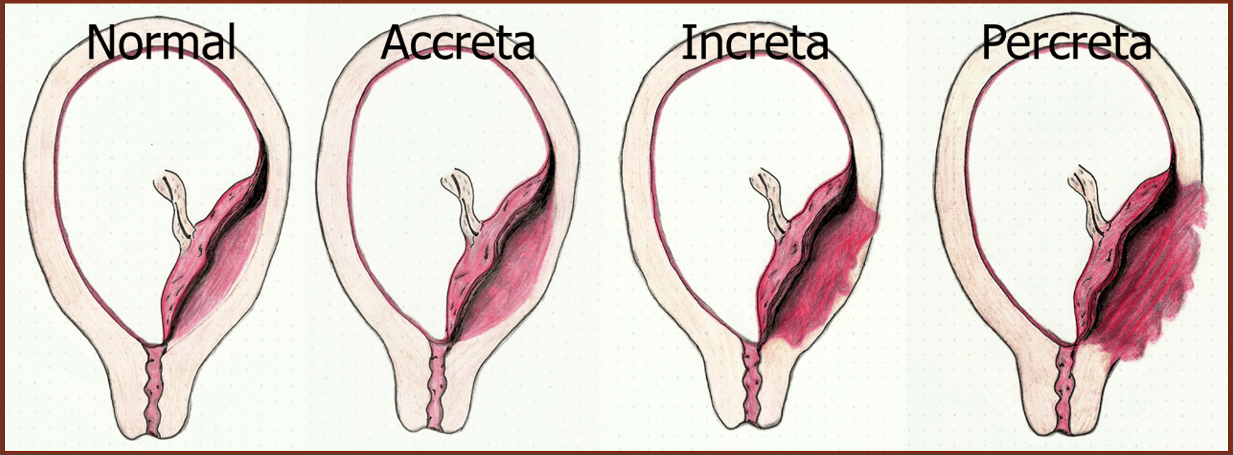 Placenta Previa — Taming the SRU
