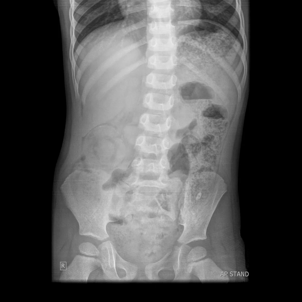 The Abdominal XRay A relic or a reliable tool? — Taming the SRU