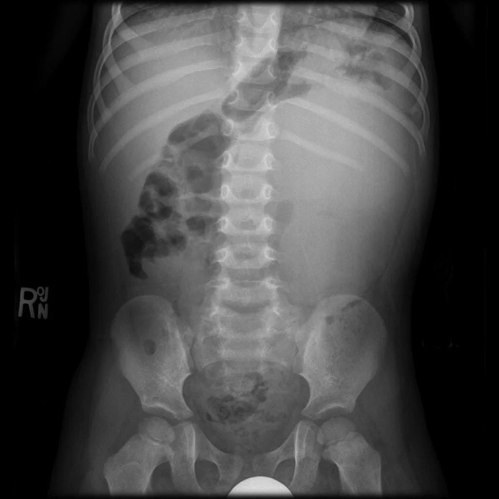 The Abdominal XRay A relic or a reliable tool? — Taming the SRU
