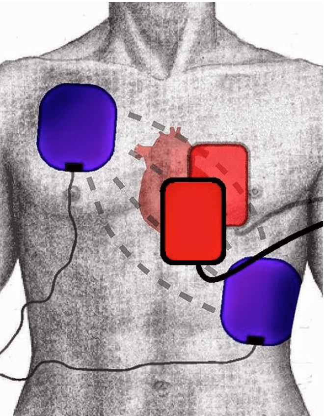 Double Sequence Defibrillation For Vfib — NUEM Blog