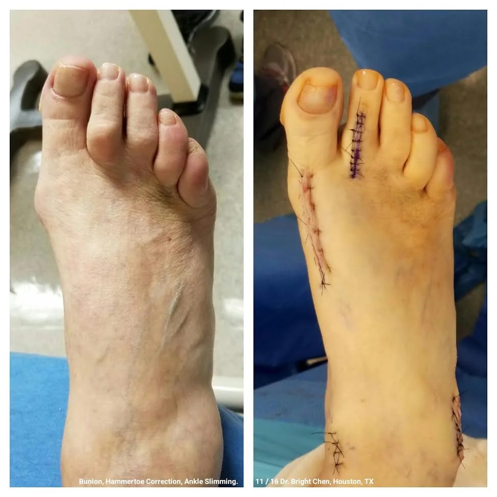 Bunion & Hammertoe Surgery — Houston Medical Clinic