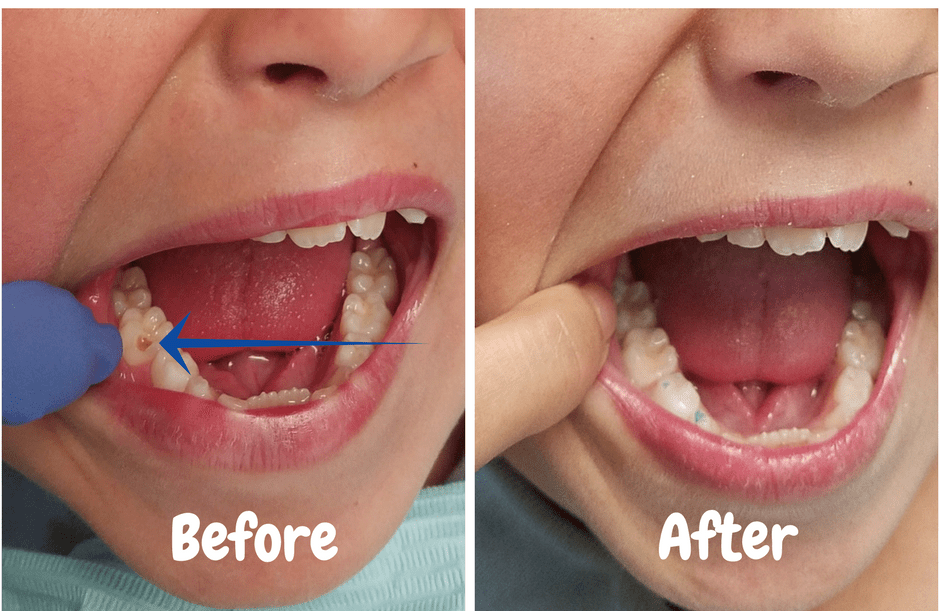 Dental Fillings / Cavity Treatment — Shanna Chirco DDS