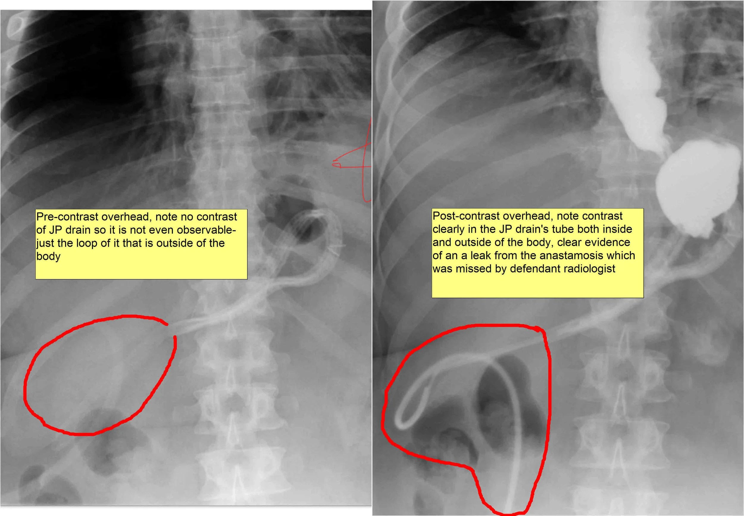 Anastomotic Leak and Death From Sepsis Following Gastric Bypass — Your