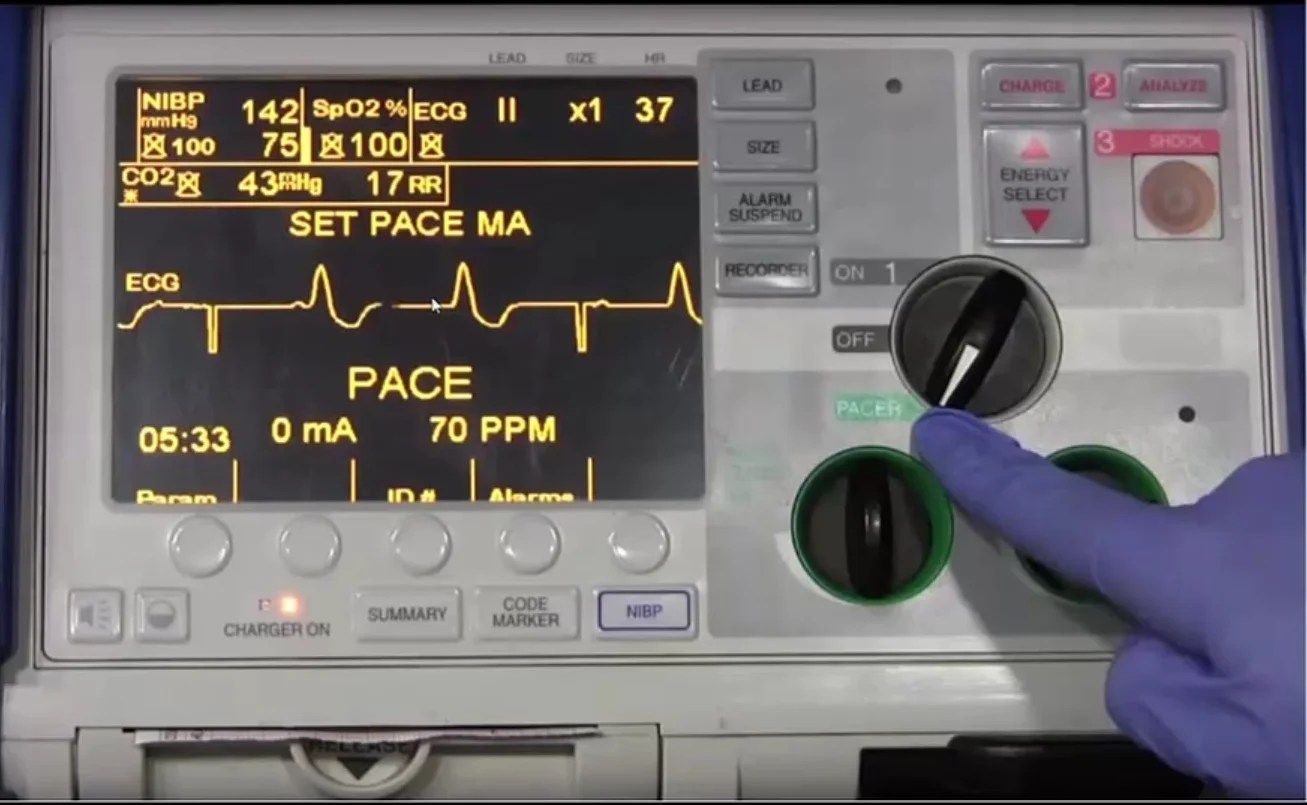 Transcutaneous Pacing — Down East Emergency Medicine