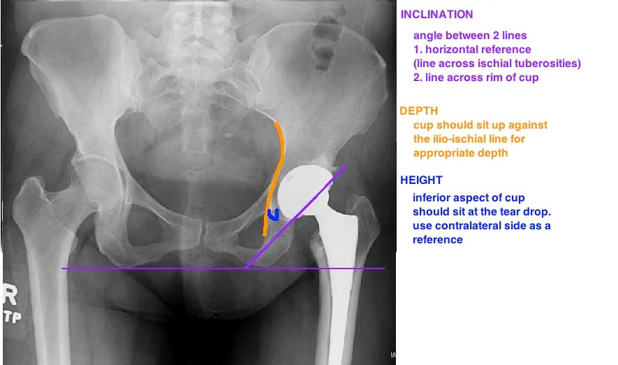 Basic Concepts of THA — Hip & Knee Book