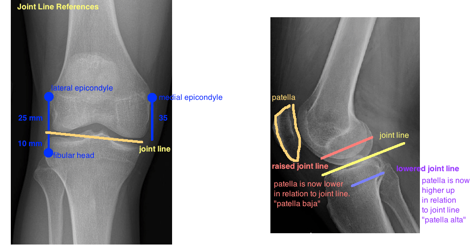 TKA KINEMATICS — Hip & Knee Book
