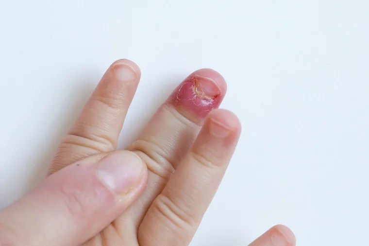 Infection Around Fingernail Cuticle Awesome Nail