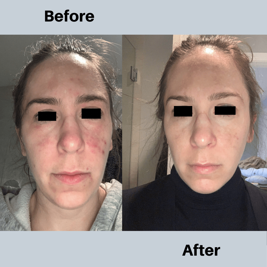 Skin care for skin picking — Stop Skin Picking Coach