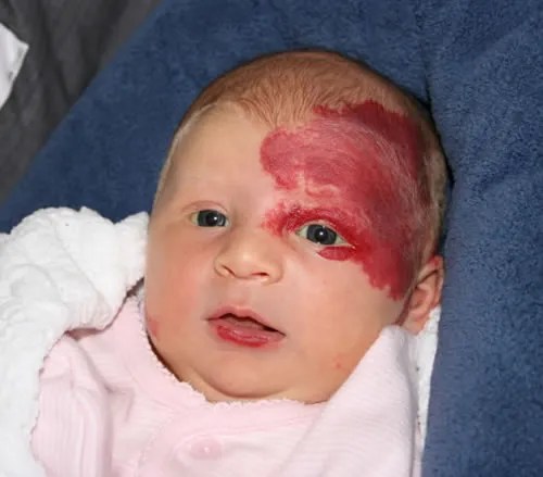 The Secret Meanings Behind Birthmarks BabyGaga