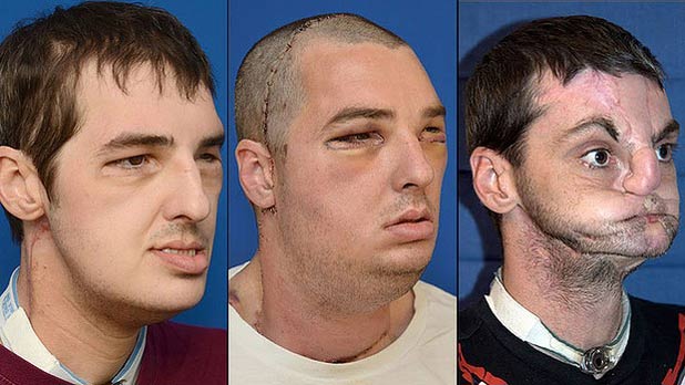 Before And After Hair Transplant Reddit Pics May Hairdo