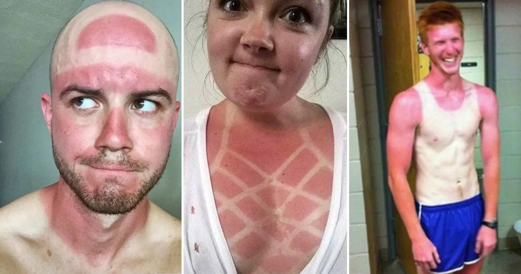 Sunburn Regrets 15 People Who DEFINITELY Should Have Worn Sunscreen