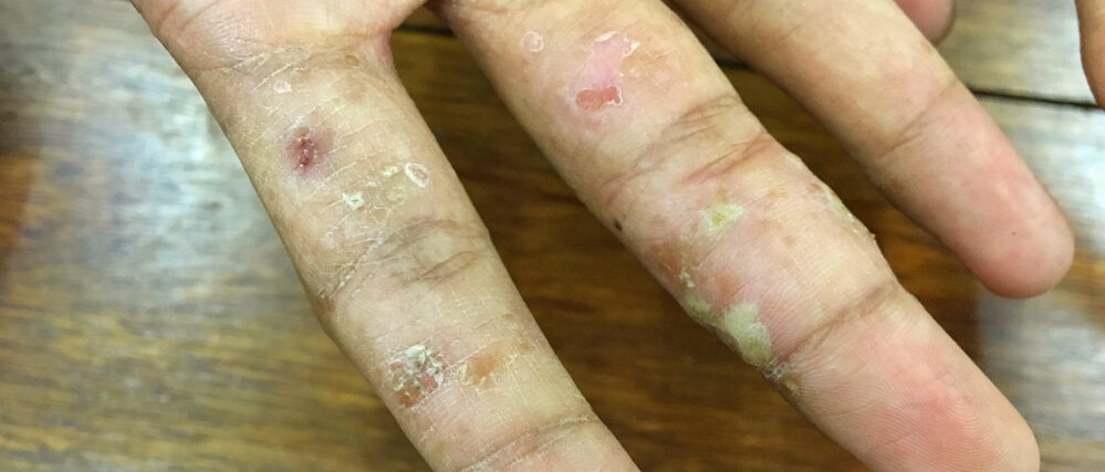Scabies STD Concern