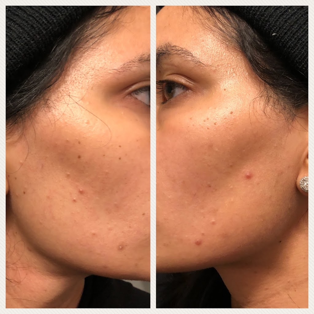 Can A Facial Ruin Your Face? · Steffanys Choice