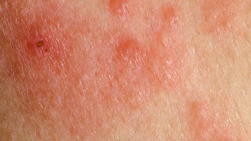 6 symptom på hudcancer du inte borde ignorera Steg för Hälsa