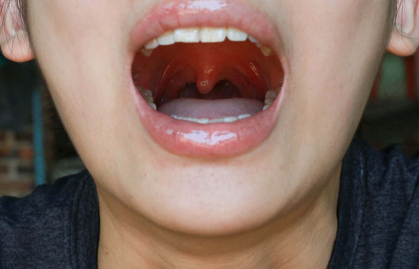 Inflammation i gomspenen varför uppstår det? Steg för Hälsa