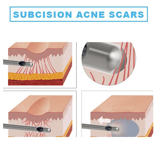 Subcision for Acne Scars STELLAR CLINIC