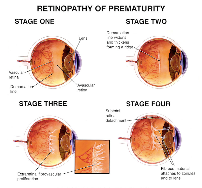 Retinopathy of Prematurity stemcellreferencestemcellreference