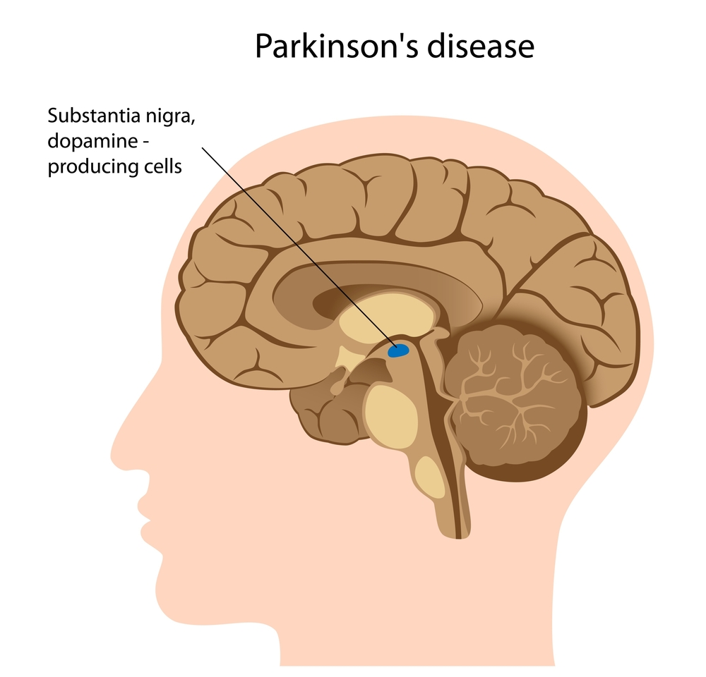 Parkinson’s Disease stemcellreference