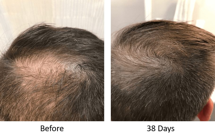 Stem Cell Therapy For Hair Loss Stemedix Regenerative Medicine Also