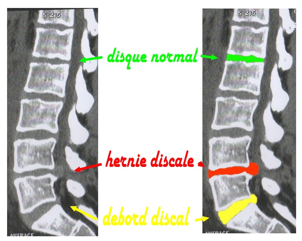Soigner l'hernie discale sans chirurgie Stéphanie Jan