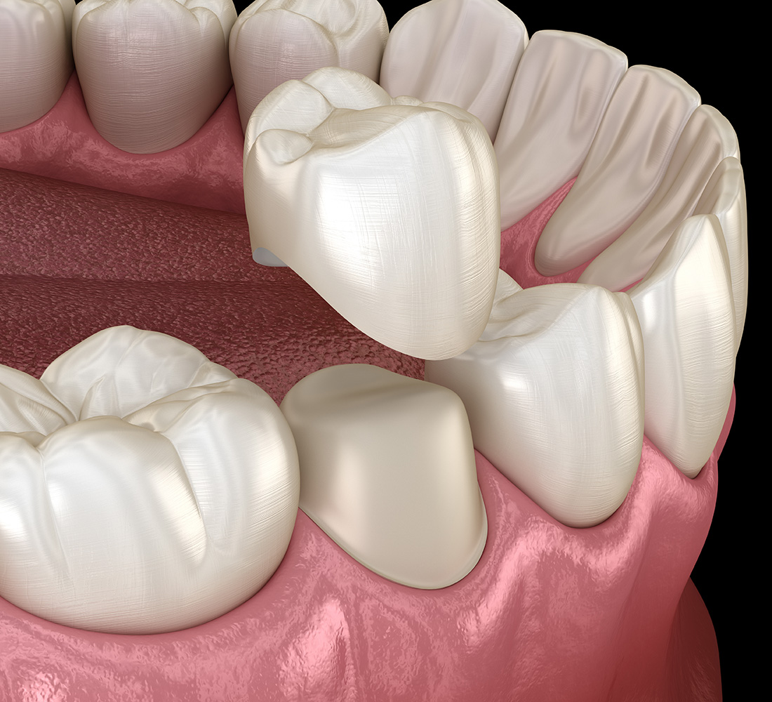 Dr. Spelman Las Vegas Dental Crowns Dental Bridges In Summerlin