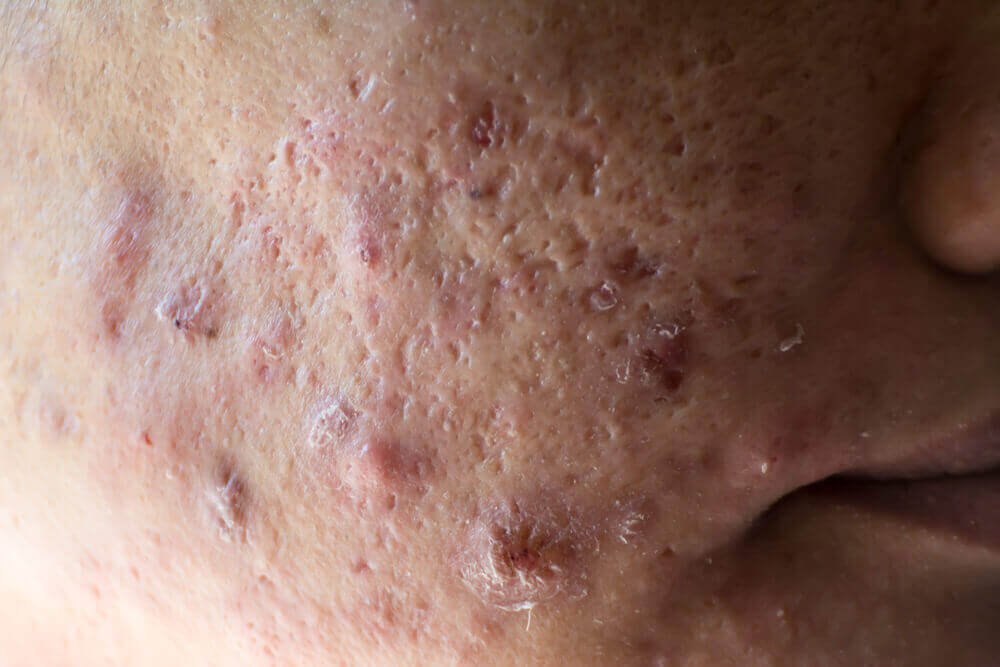  Cystic Acne is The Most Aggressive Variant of Acne