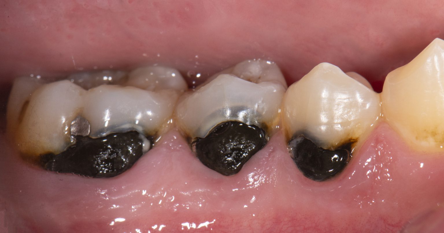 How to benefit from silver diamine fluoride for adult patients