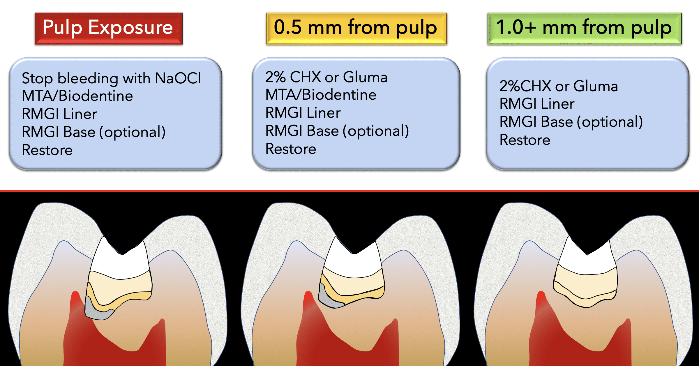 Improve Pulp Capping Success Rate Dr. Stevenson Shows You How
