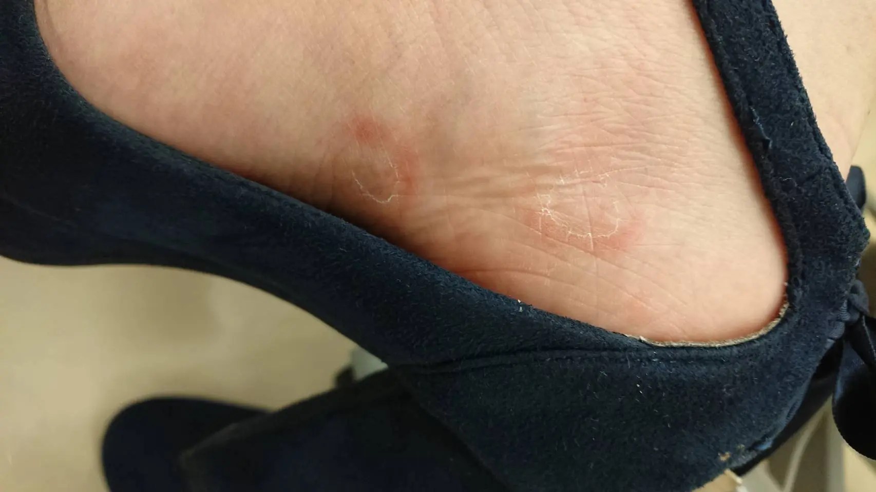 体に皮疹や湿疹がでてしまう性病 五反田(品川区)・渋谷 性病検査の感染症内科 KARADA内科クリニック