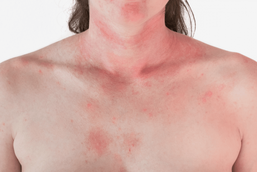 Vitamin B12 Deficiency Skin Rash
