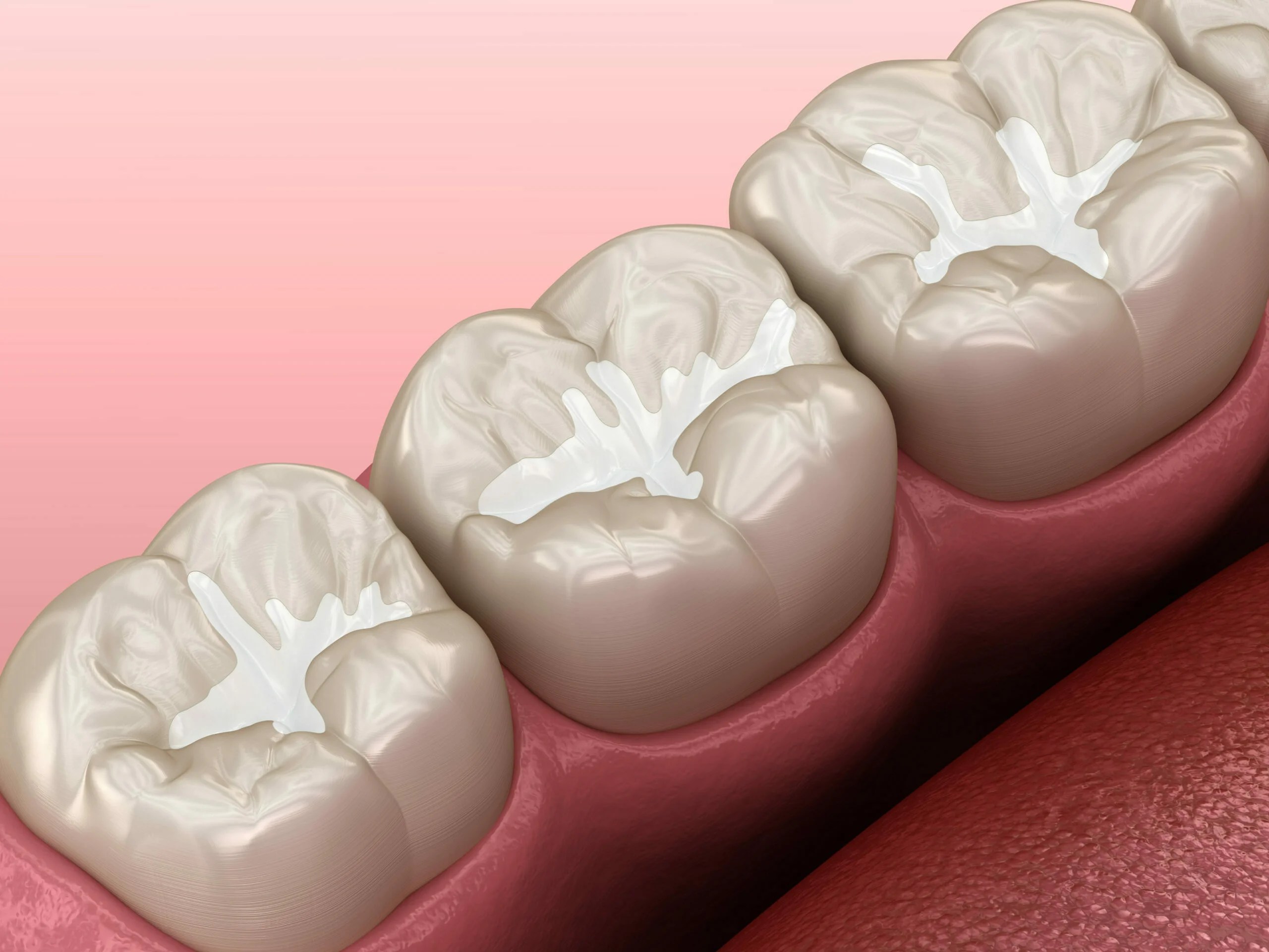 Fissure Sealants Quedgeley Dental Sealants Gloucester