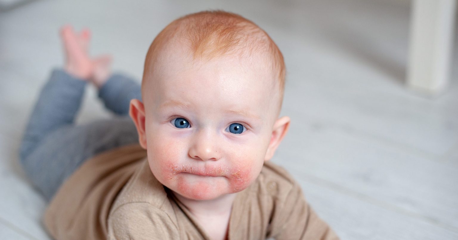 Teething Rash What is it and How To Treat It St. Johns Pediatric
