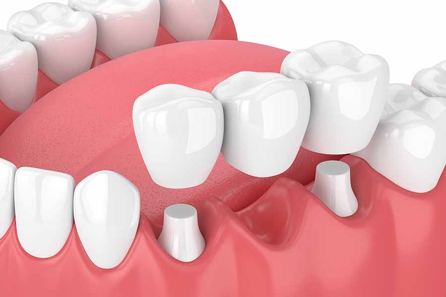 What Is the Difference Between a Dental Bridge and an Implant? » St