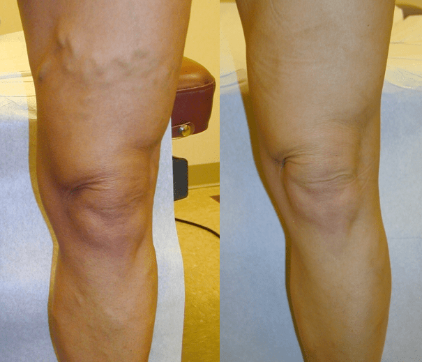 Radiofrequency Venous Ablation Treatment of Veins St. Louis Laser Vein