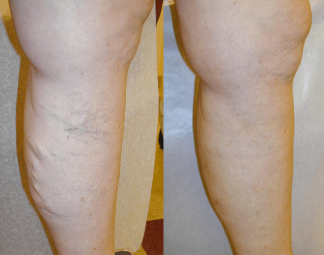 Radiofrequency Venous Ablation Treatment of Veins St. Louis Laser Vein