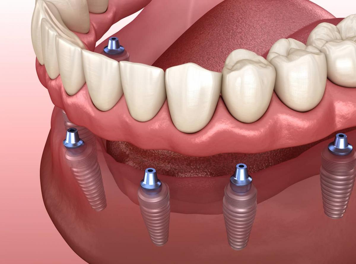 The Complete Buyer’s Guide To Implant Dentures for Dentists STOMADENT